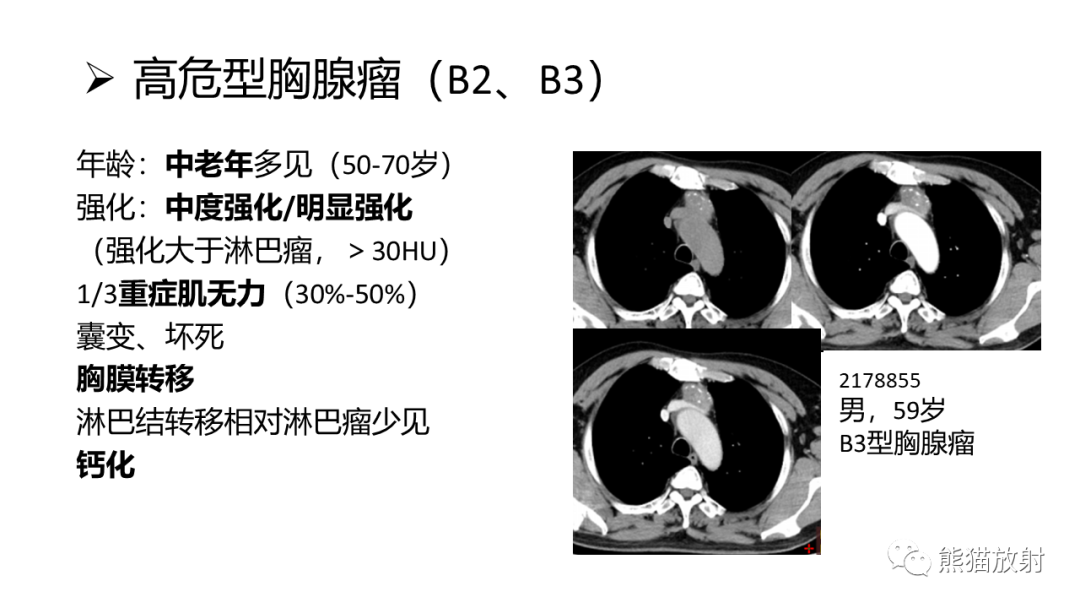 影像PPT - 【病例】纵隔淋巴瘤 VS 胸腺癌-29
