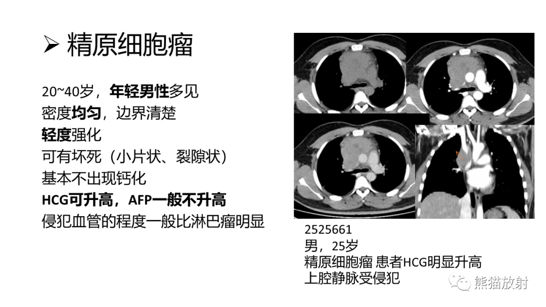 影像PPT - 【病例】纵隔淋巴瘤 VS 胸腺癌-31