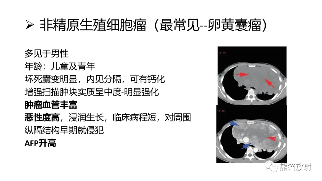 影像PPT - 【病例】纵隔淋巴瘤 VS 胸腺癌-32