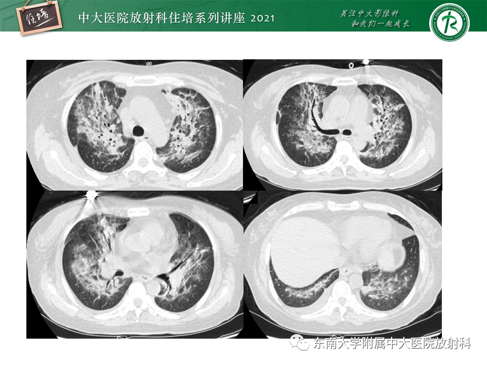 影像PPT - 【PPT】肺孢子菌肺炎-4