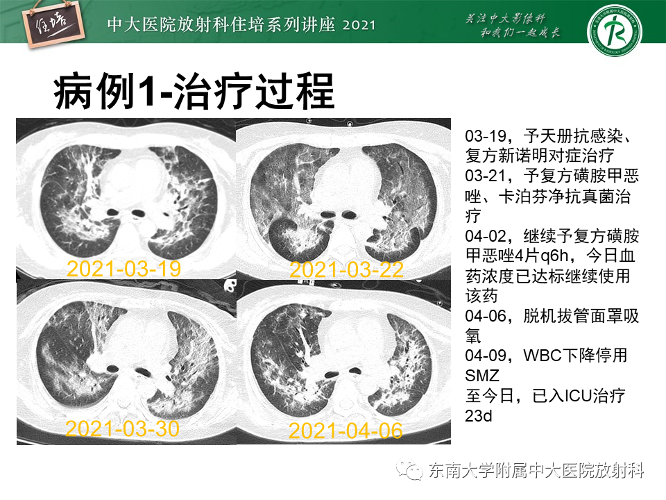 影像PPT - 【PPT】肺孢子菌肺炎-6