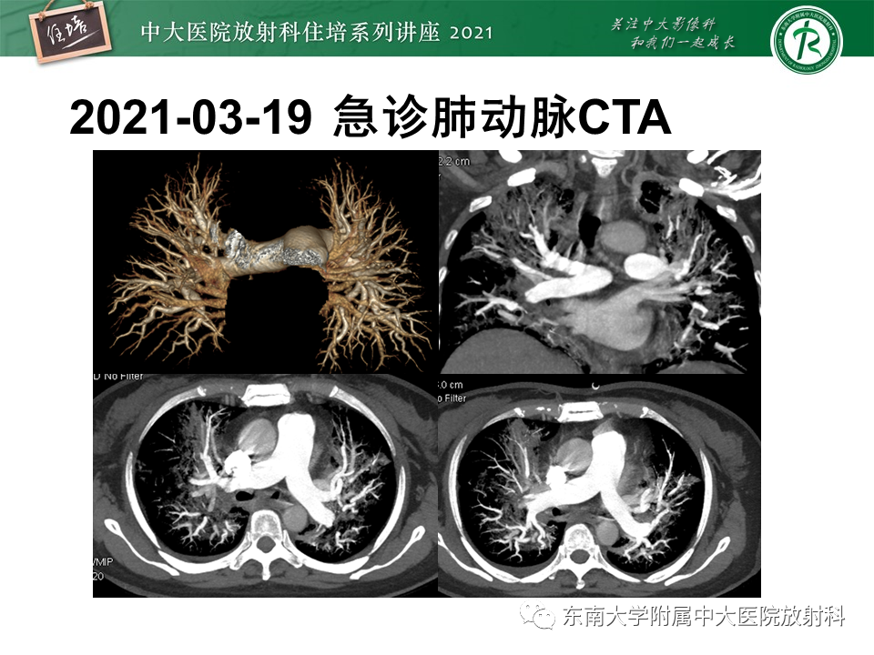 影像PPT - 【PPT】肺孢子菌肺炎-3