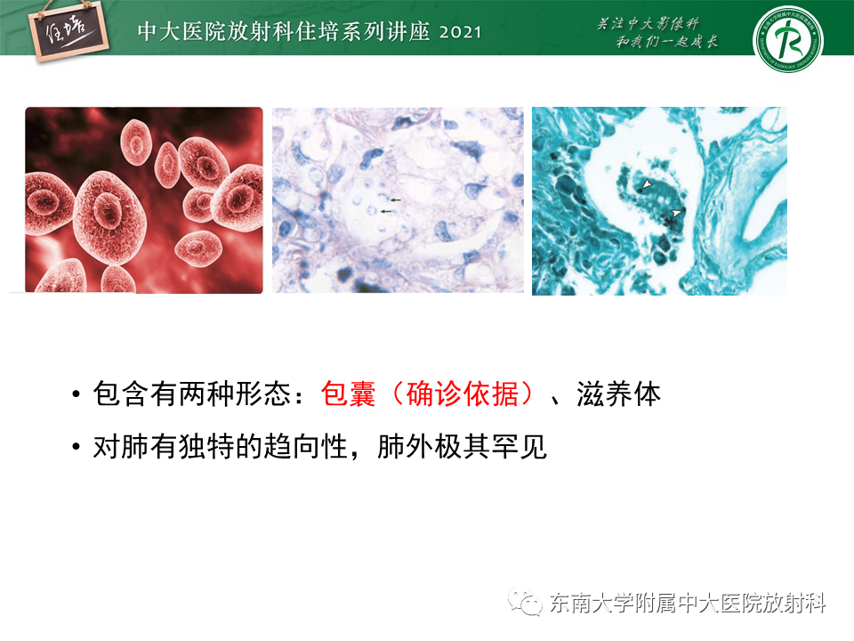 影像PPT - 【PPT】肺孢子菌肺炎-9