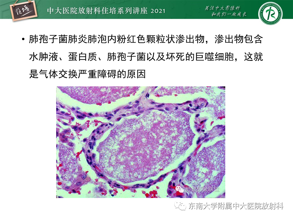 影像PPT - 【PPT】肺孢子菌肺炎-11