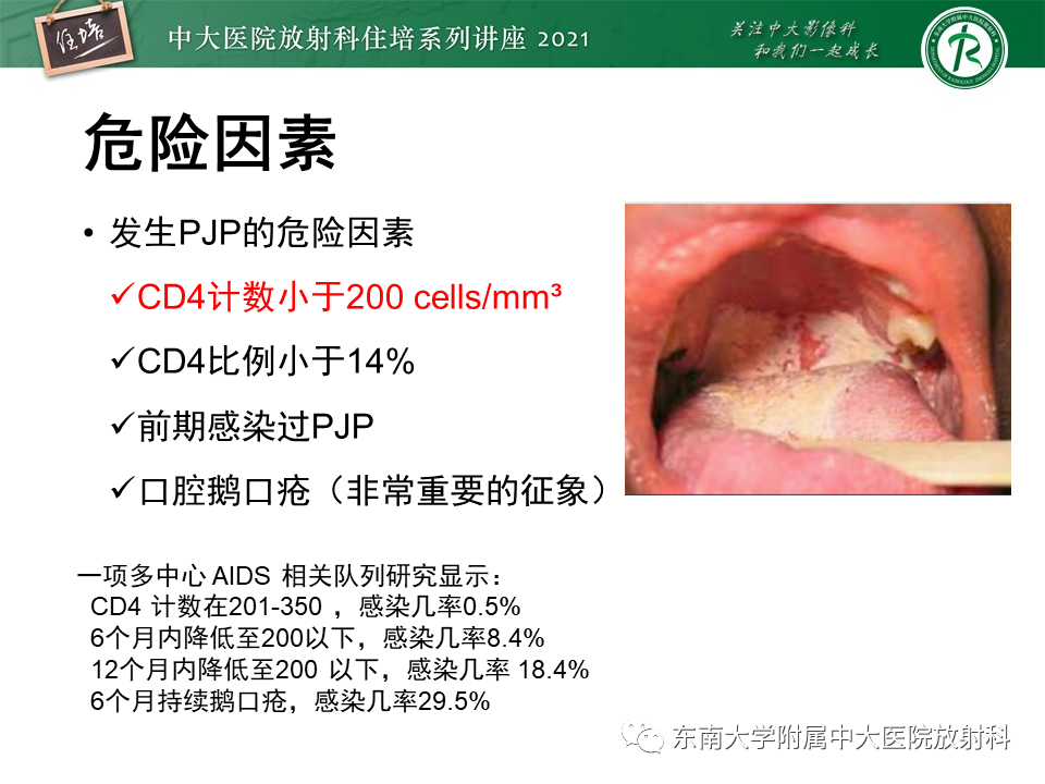 影像PPT - 【PPT】肺孢子菌肺炎-16