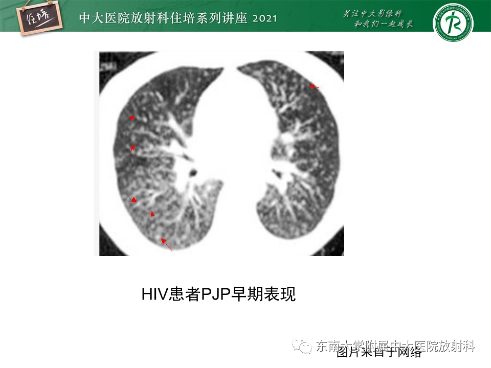 影像PPT - 【PPT】肺孢子菌肺炎-21