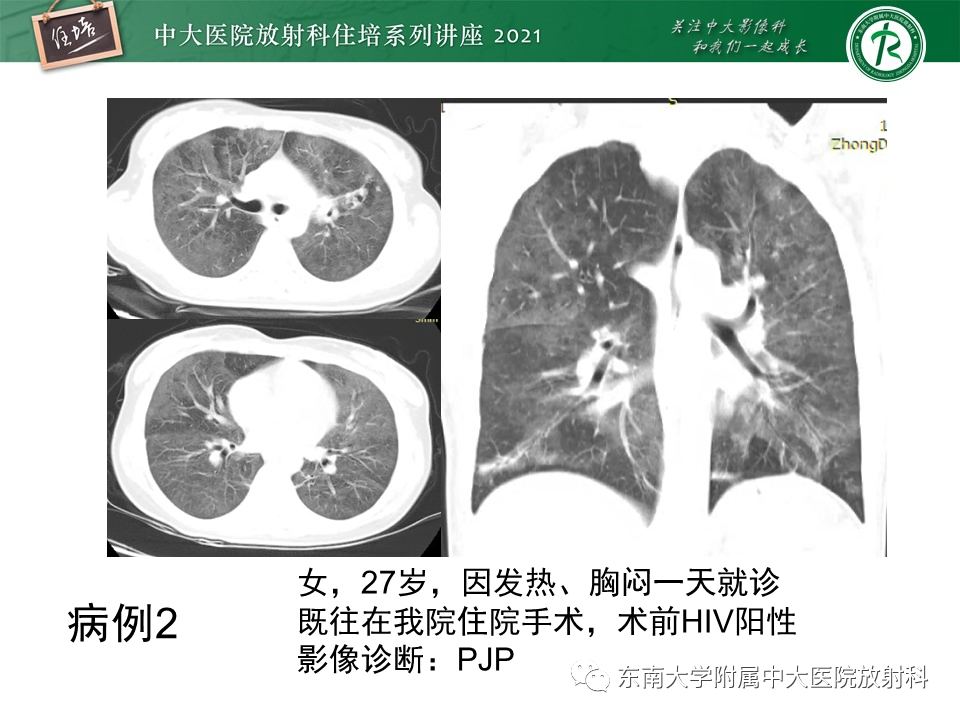 影像PPT - 【PPT】肺孢子菌肺炎-22
