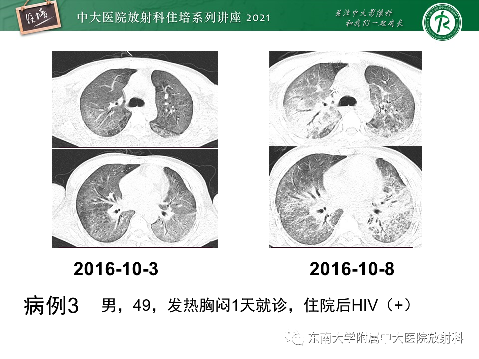 影像PPT - 【PPT】肺孢子菌肺炎-23