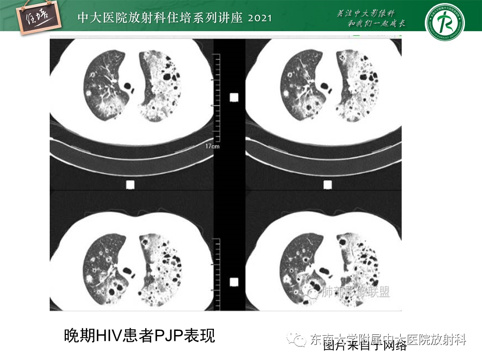 影像PPT - 【PPT】肺孢子菌肺炎-24