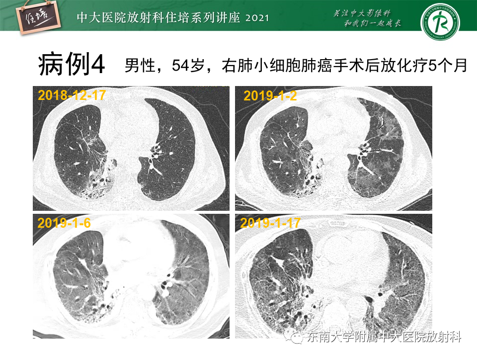 影像PPT - 【PPT】肺孢子菌肺炎-26