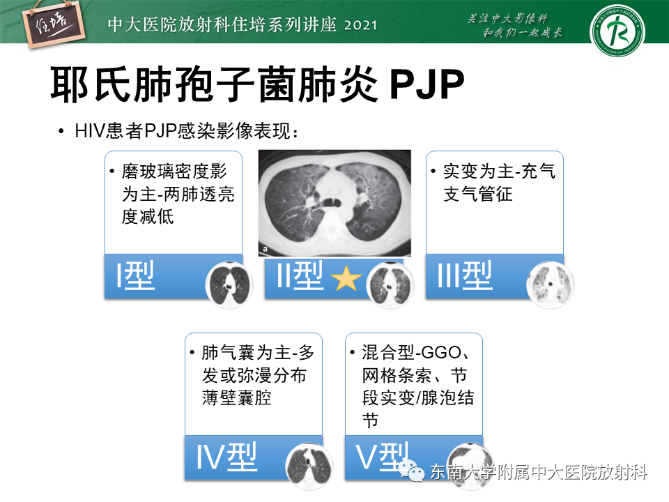 影像PPT - 【PPT】肺孢子菌肺炎-27