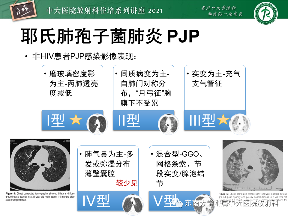 影像PPT - 【PPT】肺孢子菌肺炎-28