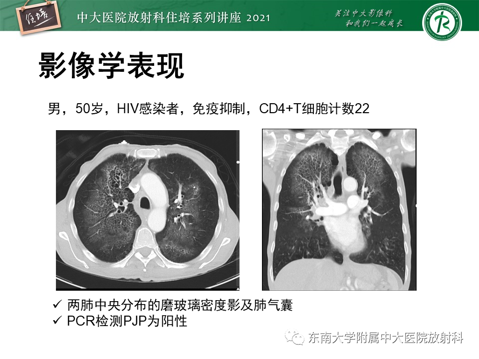 影像PPT - 【PPT】肺孢子菌肺炎-29