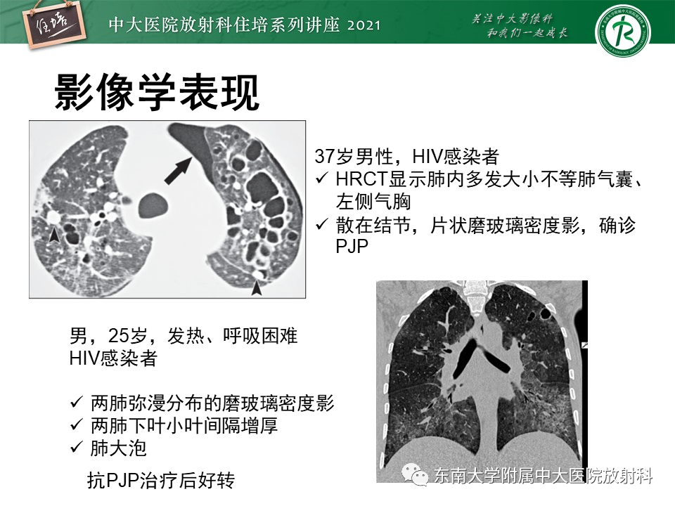 影像PPT - 【PPT】肺孢子菌肺炎-30