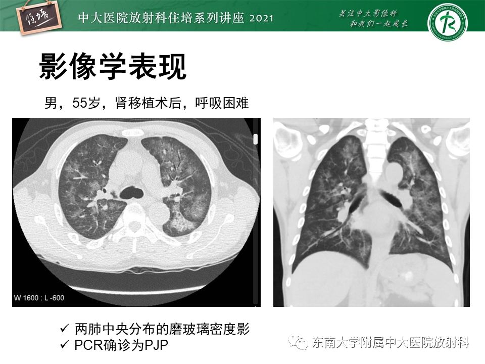 影像PPT - 【PPT】肺孢子菌肺炎-31