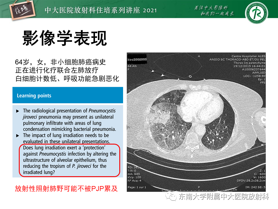影像PPT - 【PPT】肺孢子菌肺炎-32