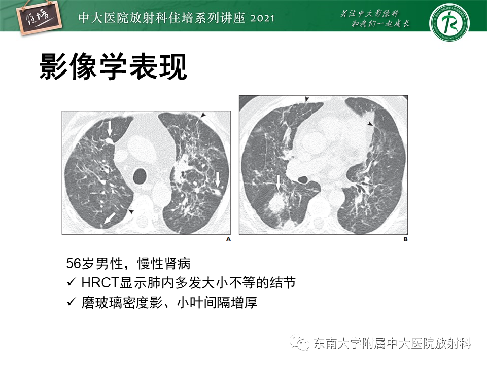 影像PPT - 【PPT】肺孢子菌肺炎-34
