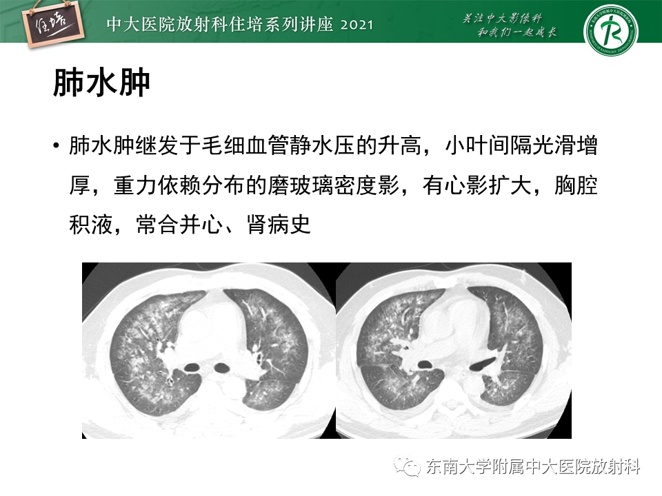影像PPT - 【PPT】肺孢子菌肺炎-41