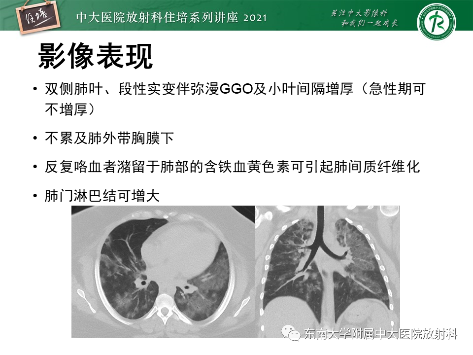 影像PPT - 【PPT】肺孢子菌肺炎-43