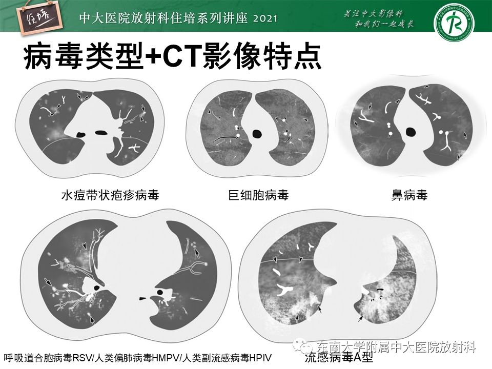影像PPT - 【PPT】肺孢子菌肺炎-45