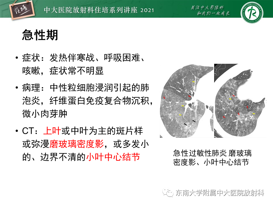 影像PPT - 【PPT】肺孢子菌肺炎-47