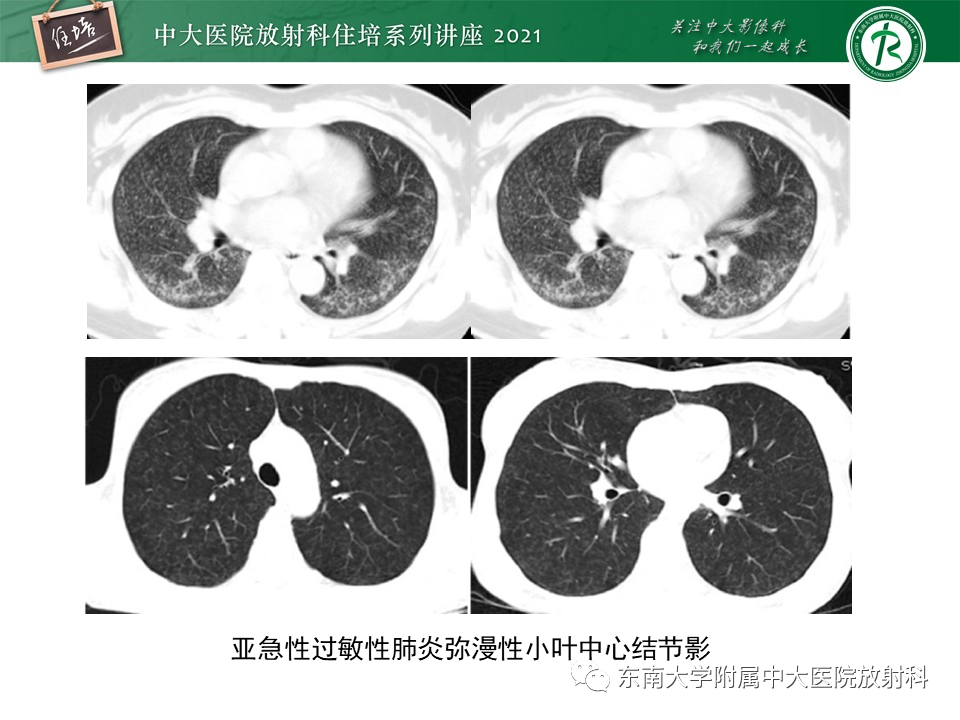 影像PPT - 【PPT】肺孢子菌肺炎-49