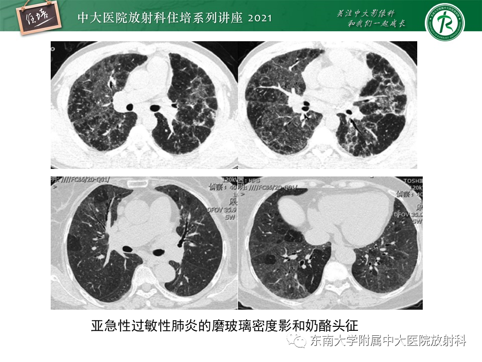 影像PPT - 【PPT】肺孢子菌肺炎-50