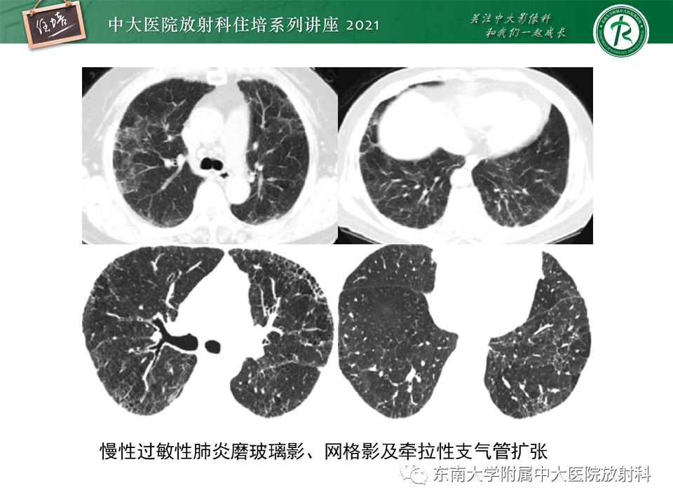 影像PPT - 【PPT】肺孢子菌肺炎-52