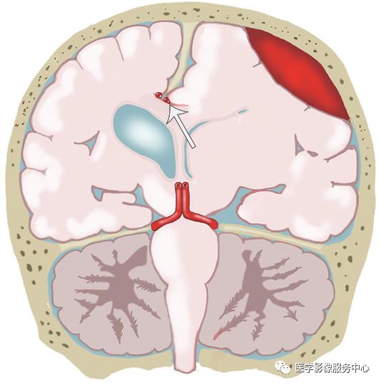影像PPT - 脑疝的类型及其影像学特点-8 影像PPT - 脑疝的类型及其影像学特点-8