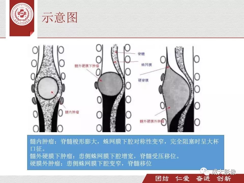 影像PPT - 【PPT】椎管内肿瘤脊膜瘤的MRI诊断-5