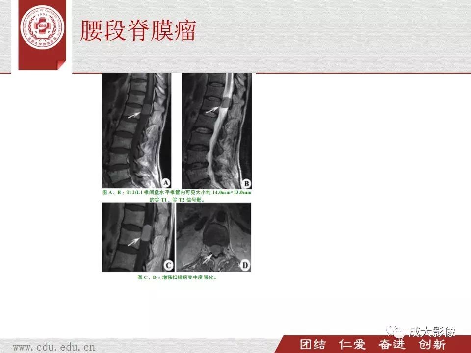 影像PPT - 【PPT】椎管内肿瘤脊膜瘤的MRI诊断-12