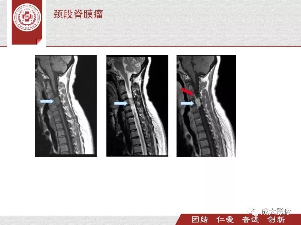 影像PPT - 【PPT】椎管内肿瘤脊膜瘤的MRI诊断-11