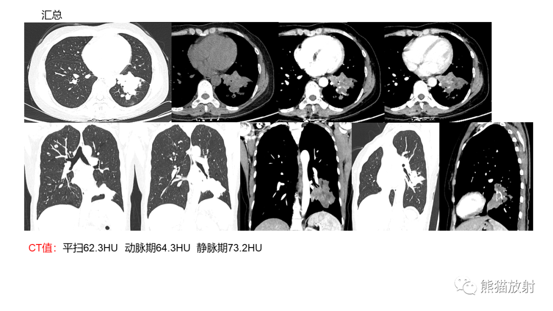 影像PPT - 【病例】肺黏液腺癌2例CT影像-11