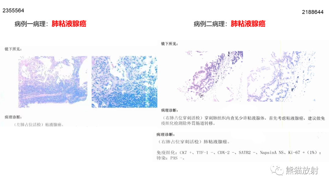 影像PPT - 【病例】肺黏液腺癌2例CT影像-21