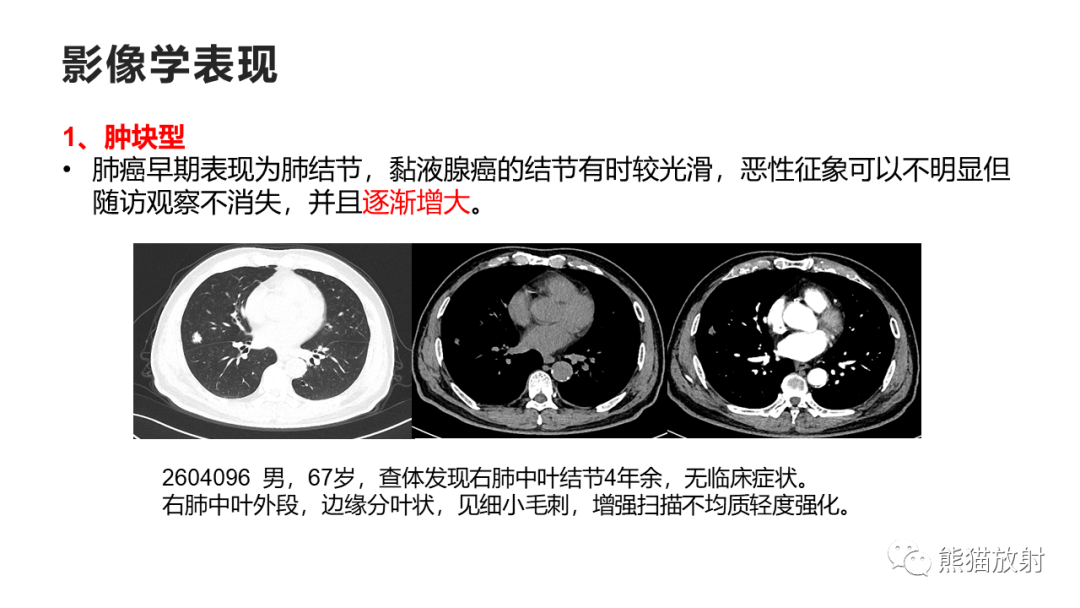 影像PPT - 【病例】肺黏液腺癌2例CT影像-25
