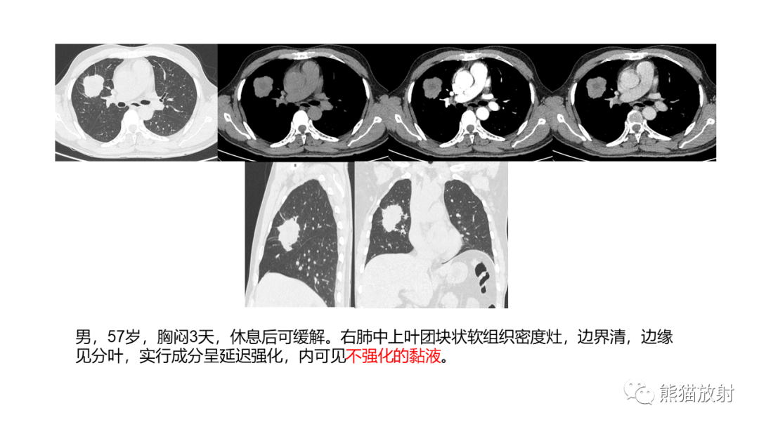 影像PPT - 【病例】肺黏液腺癌2例CT影像-26