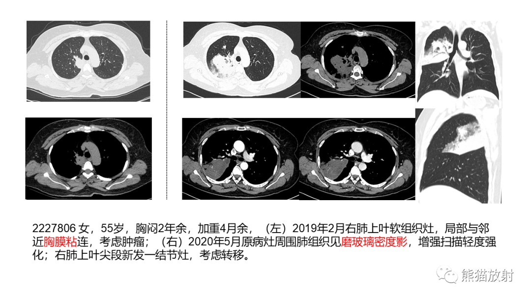 影像PPT - 【病例】肺黏液腺癌2例CT影像-27