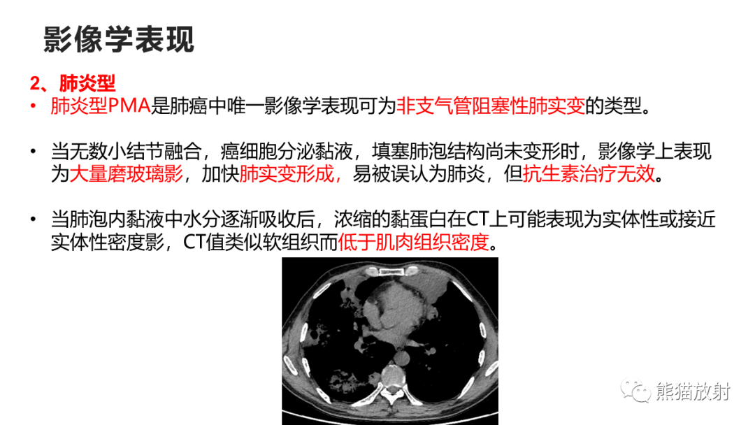 影像PPT - 【病例】肺黏液腺癌2例CT影像-28