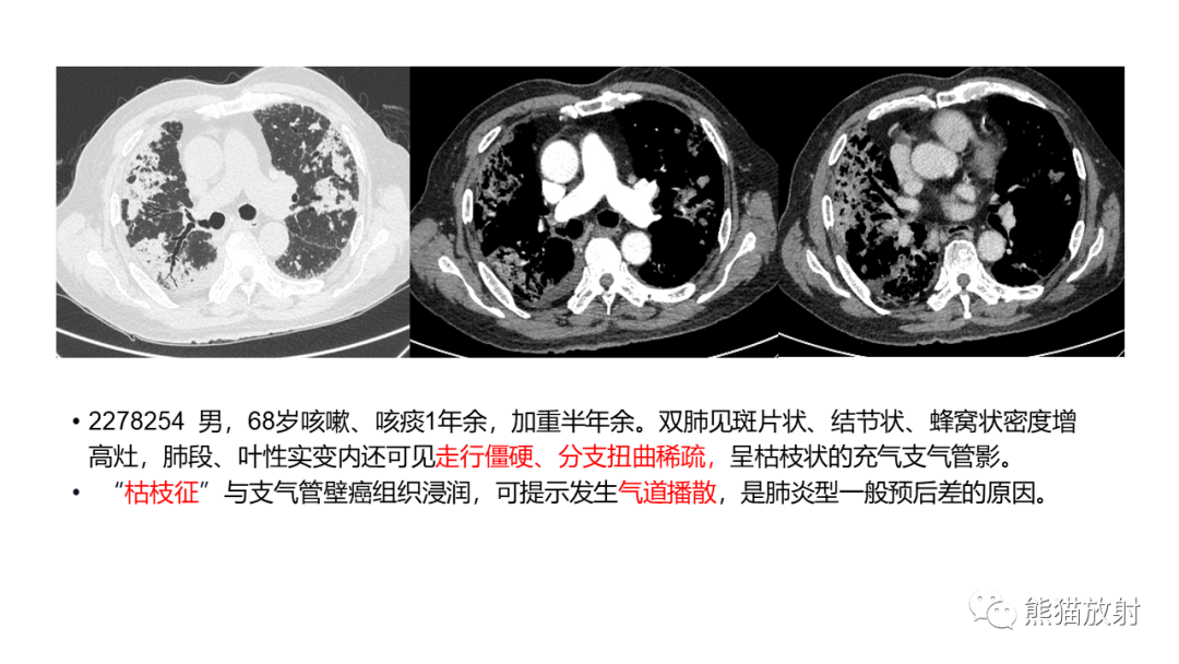 影像PPT - 【病例】肺黏液腺癌2例CT影像-31