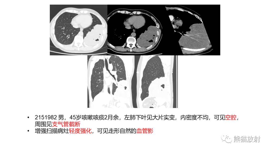 影像PPT - 【病例】肺黏液腺癌2例CT影像-30