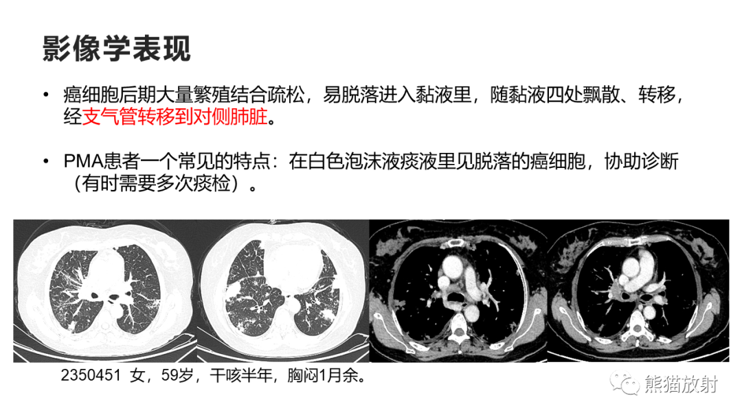 影像PPT - 【病例】肺黏液腺癌2例CT影像-32