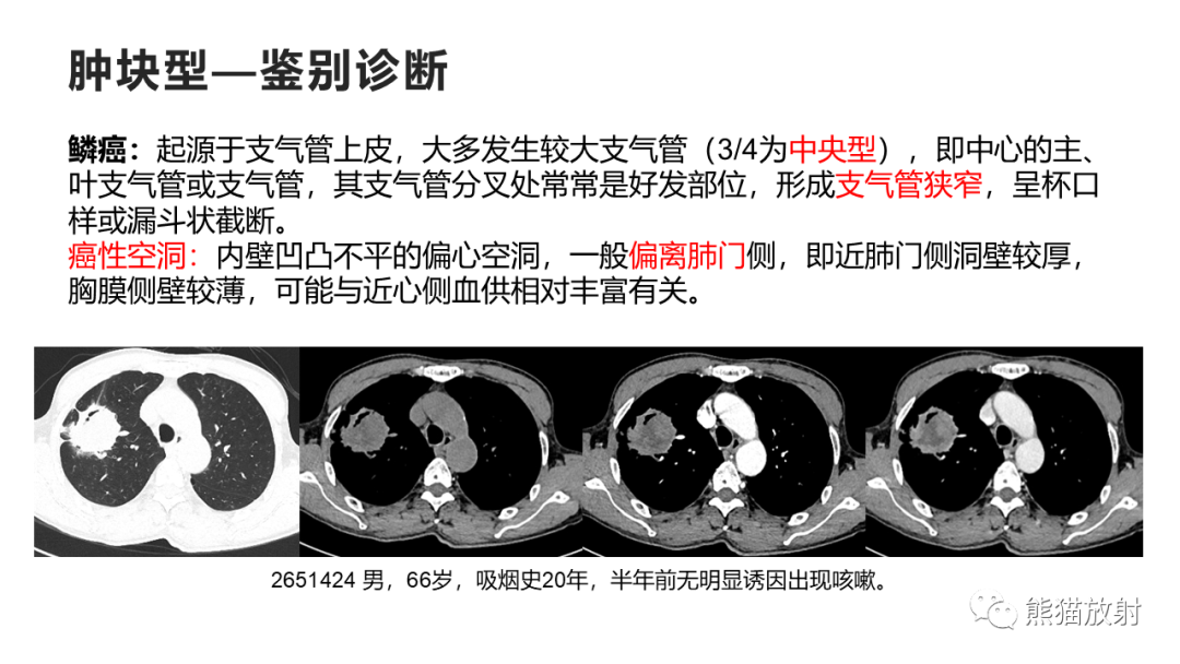 影像PPT - 【病例】肺黏液腺癌2例CT影像-36
