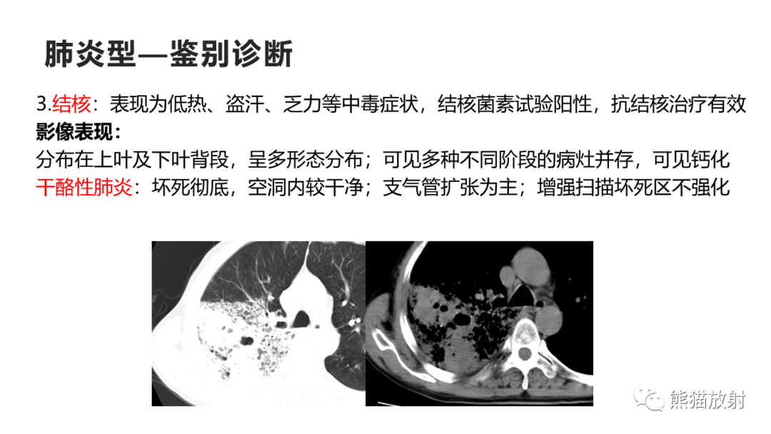 影像PPT - 【病例】肺黏液腺癌2例CT影像-39