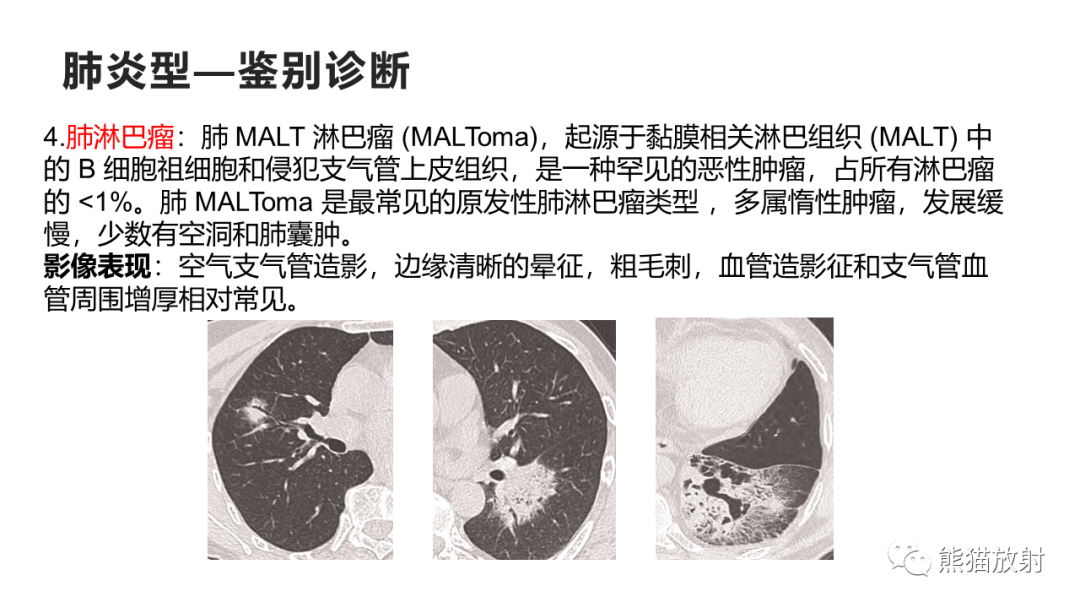 影像PPT - 【病例】肺黏液腺癌2例CT影像-40
