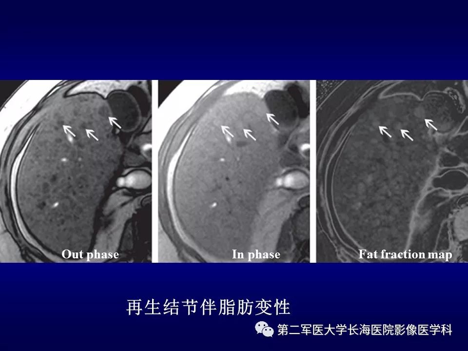 影像PPT - 肝细胞性结节的病理特点及影像诊断-12