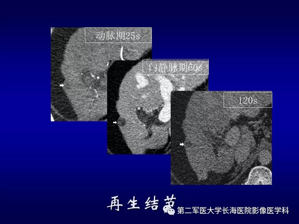 影像PPT - 肝细胞性结节的病理特点及影像诊断-11