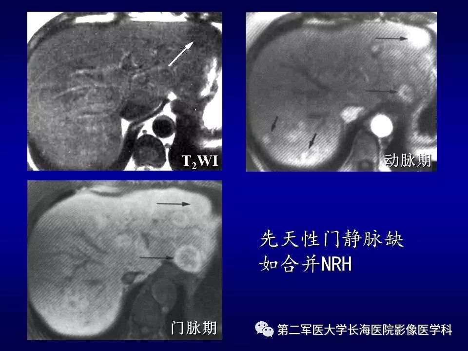 影像PPT - 肝细胞性结节的病理特点及影像诊断-10