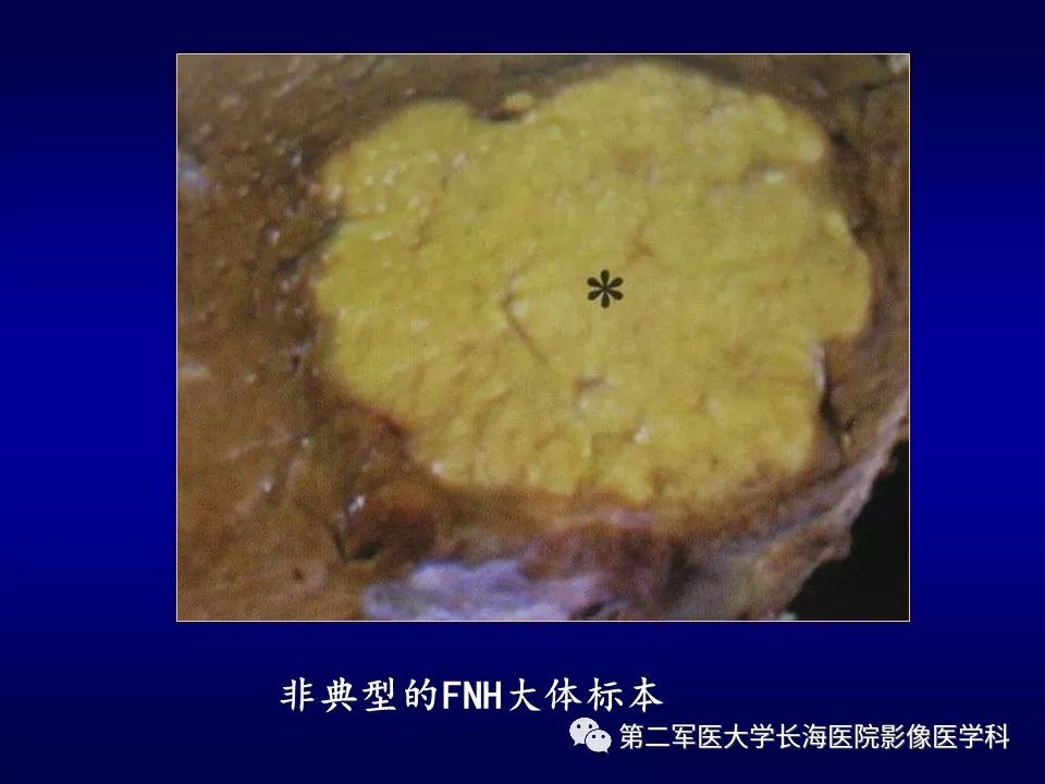 影像PPT - 肝细胞性结节的病理特点及影像诊断-18