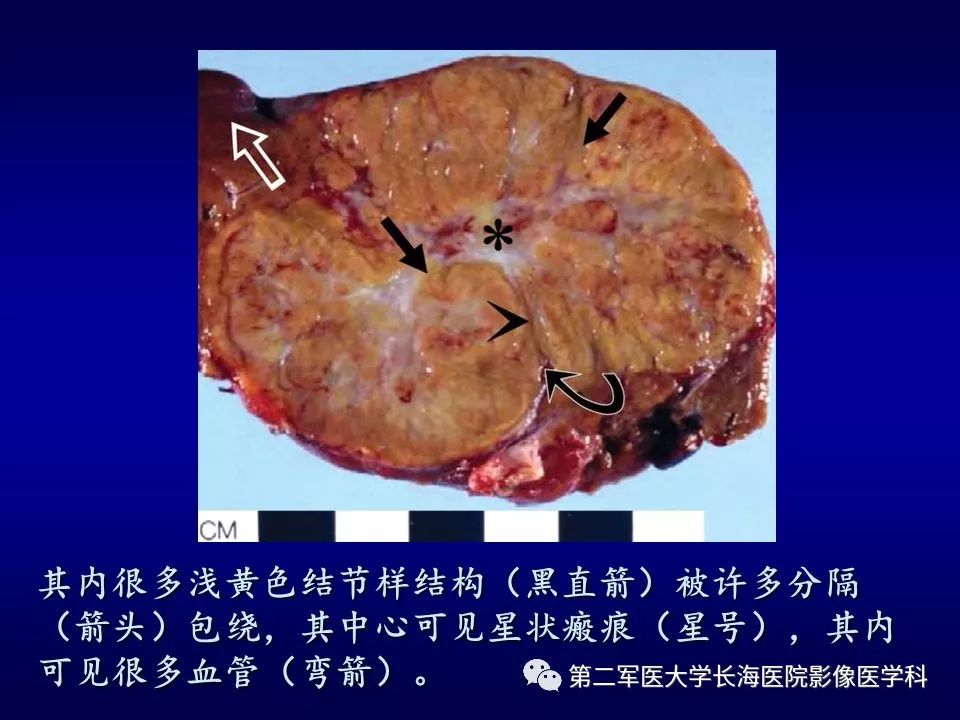 影像PPT - 肝细胞性结节的病理特点及影像诊断-16