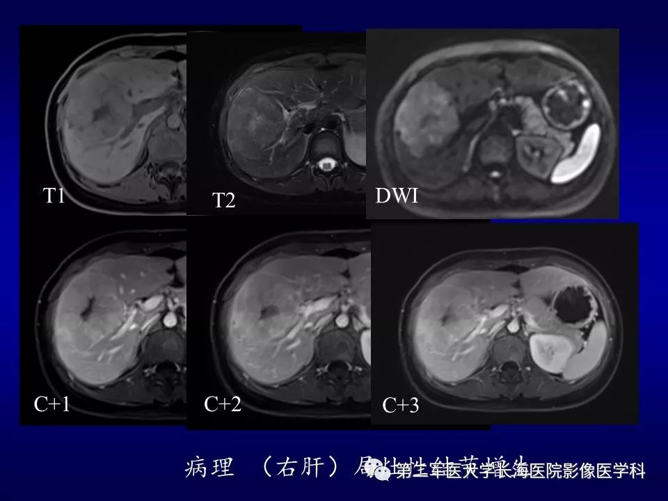 影像PPT - 肝细胞性结节的病理特点及影像诊断-20